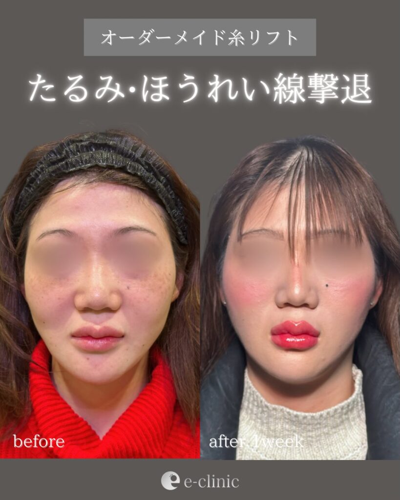 糸リフトの症例写真 (34)