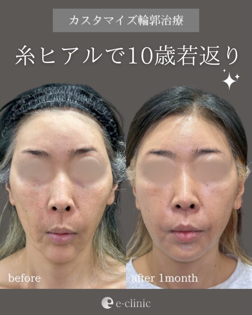 糸リフトの症例写真 (32)