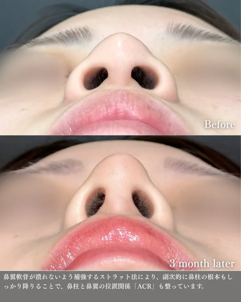 鼻整形（鼻フル）鼻尖形成と軟骨移植とプロテーゼと小鼻縮小の症例写真（名医のeクリニック伊藤渉医師が執刀）