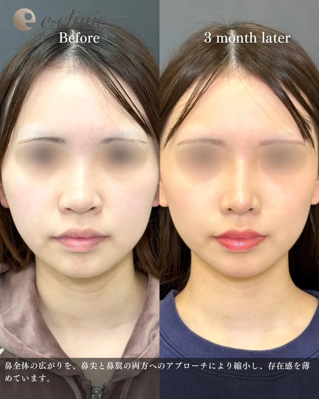 鼻整形（鼻フル）鼻尖形成と軟骨移植とプロテーゼと小鼻縮小の症例写真（名医のeクリニック伊藤渉医師が執刀）