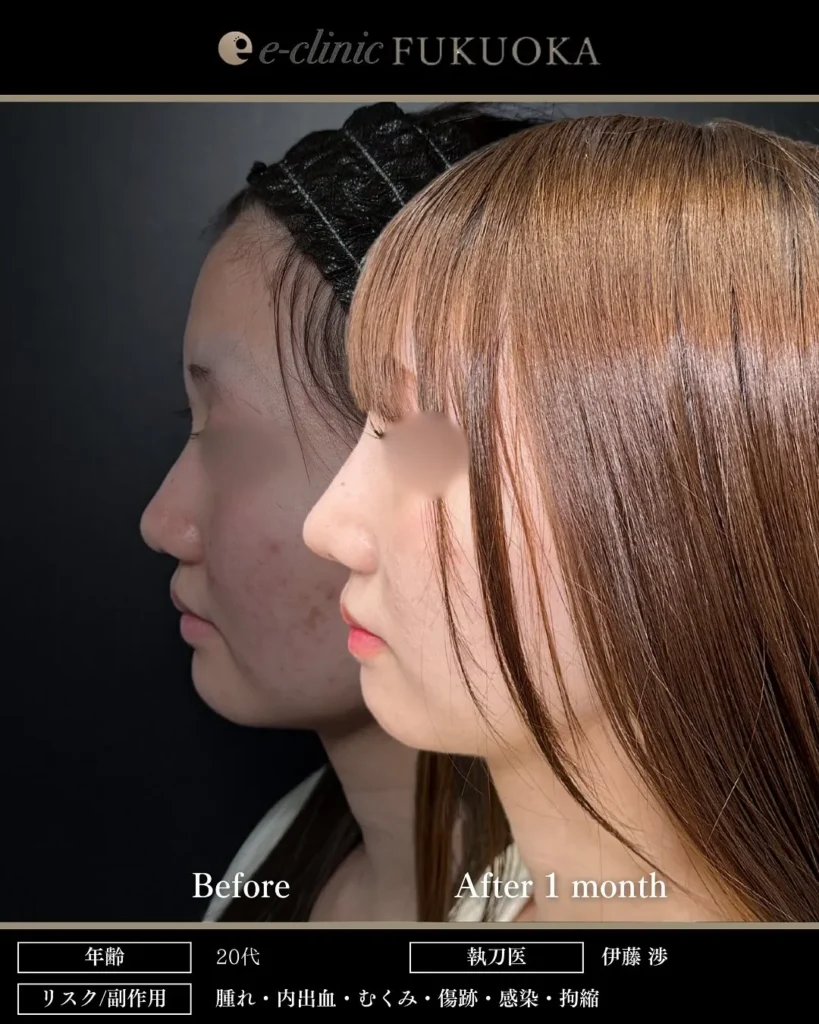 鼻整形（鼻フル）鼻尖形成と耳介軟骨移植と鼻のプロテーゼの症例写真（名医のeクリニック伊藤渉医師が執刀）