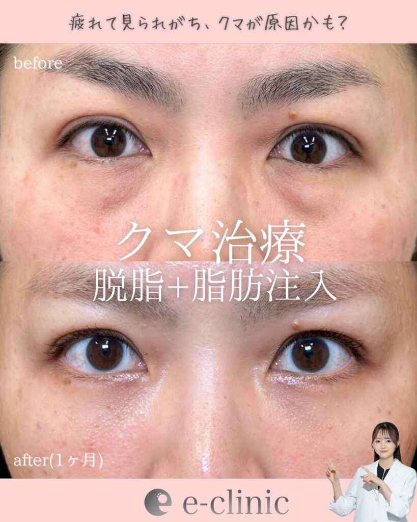 脱脂と脂肪注入の症例写真 (3)