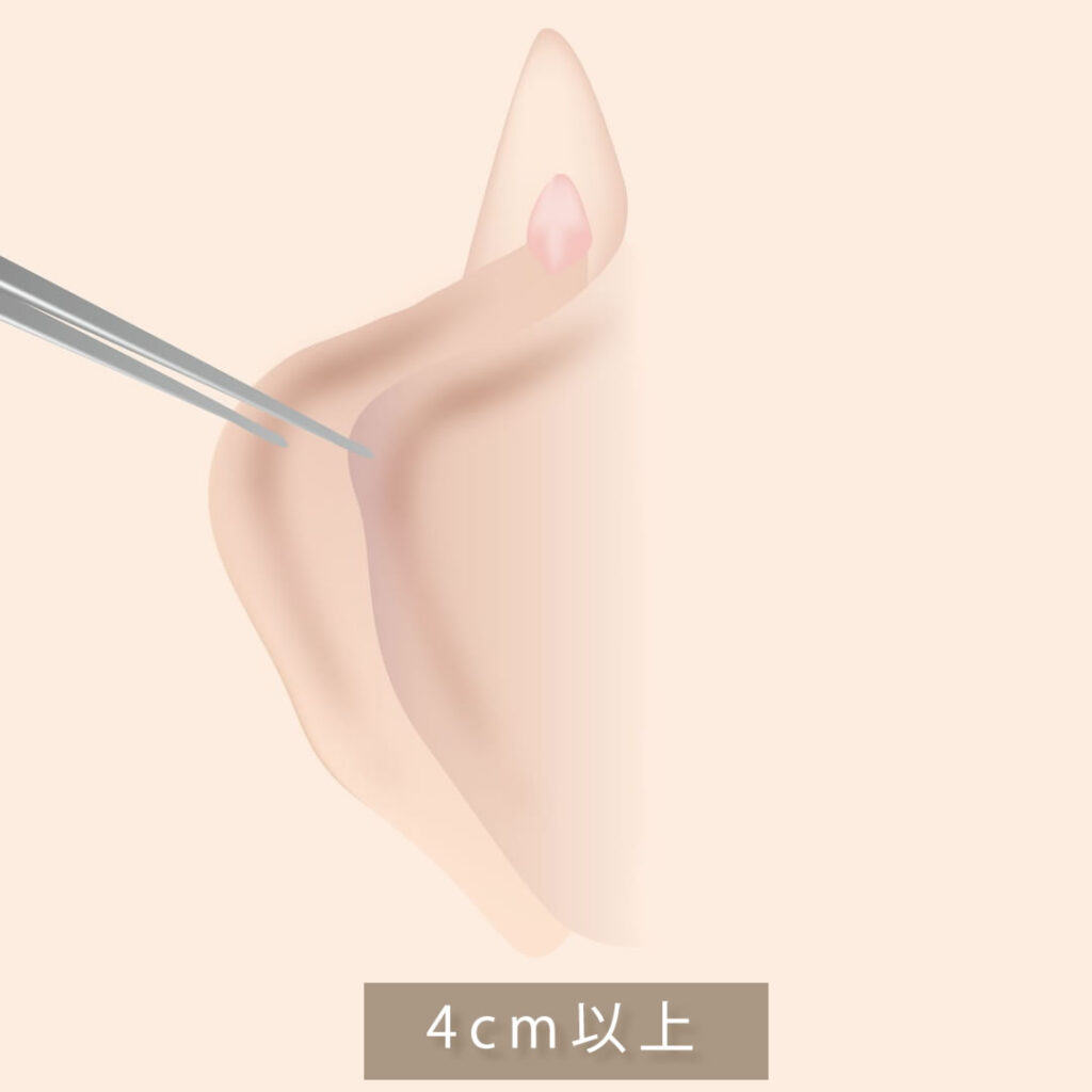 大きい小陰唇の図解