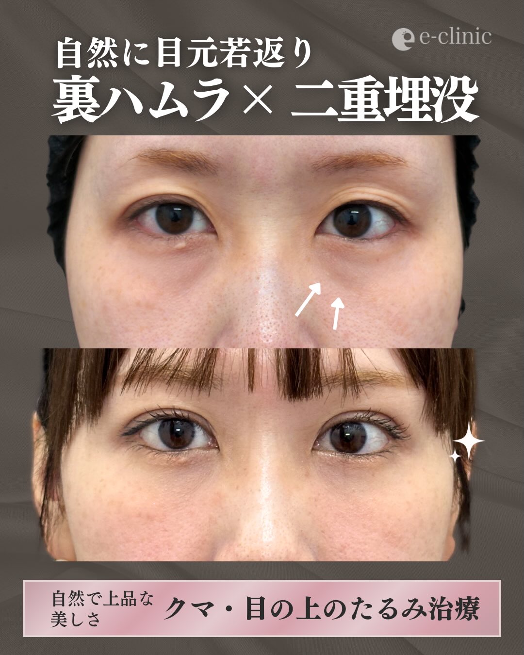 裏ハムラ法と埋没法の症例写真 (2)