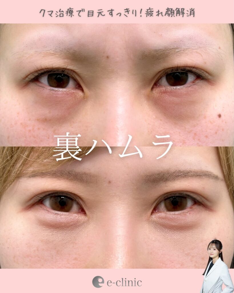 裏ハムラ法の症例写真 (27)