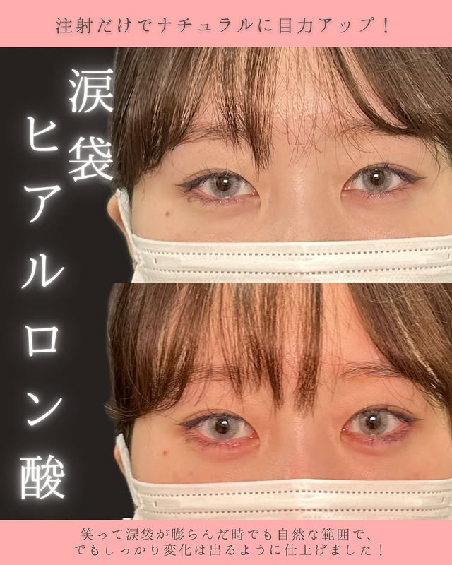 涙袋のヒアルロン酸の症例写真 (3)