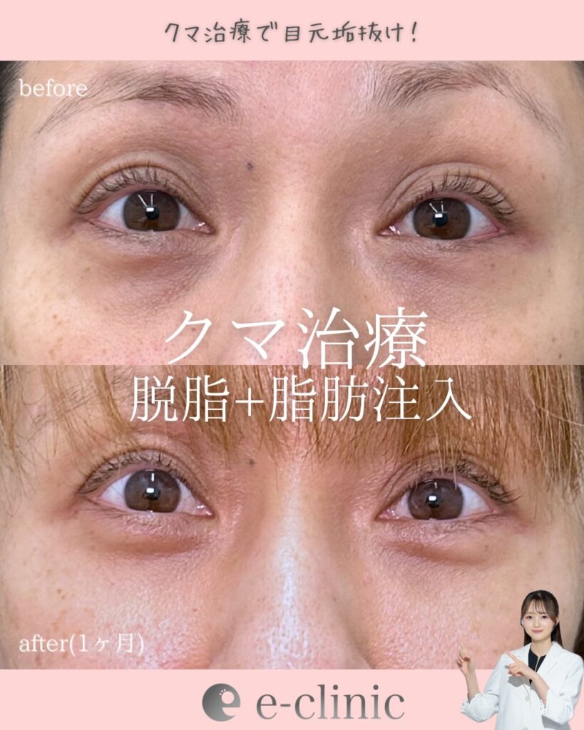 脱脂と脂肪注入の症例写真 (4)