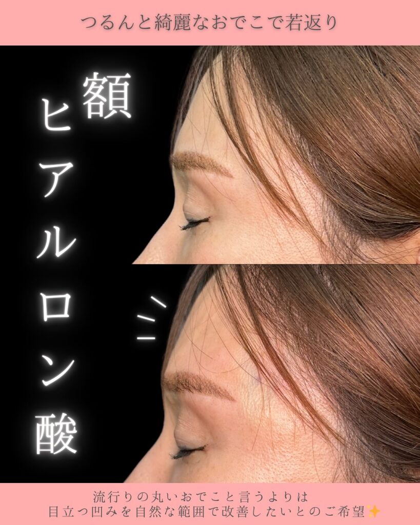 額のヒアルロン酸の症例写真 (3)