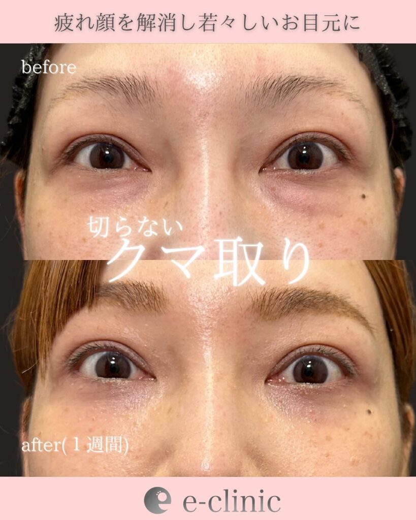 経結膜脱脂の症例写真 (1)