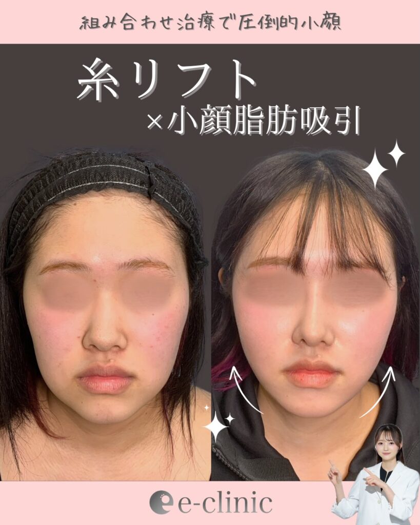 糸リフトと小顔脂肪吸引の症例写真