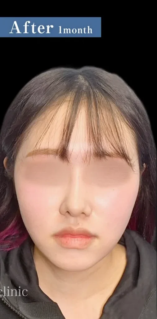 糸リフト＋脂肪吸引（顎下・頬ジョール）（辻一七子）（256） 1 (1)