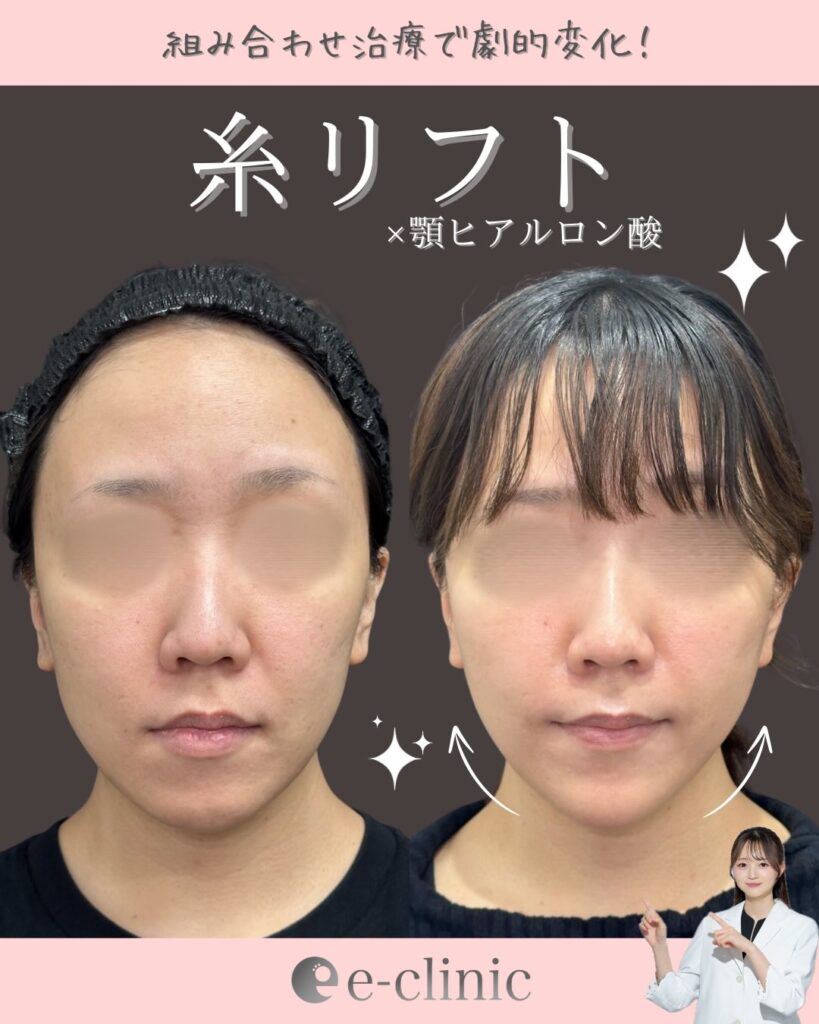 糸リフトと顎のヒアルロン酸の症例写真