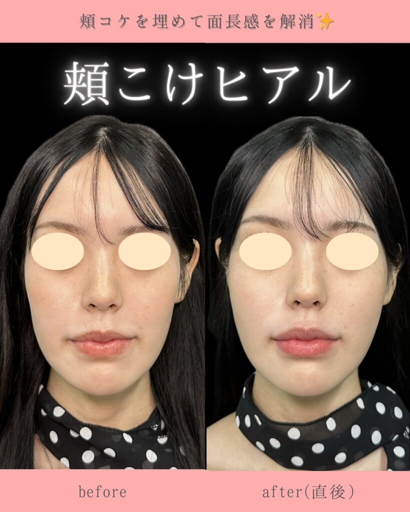 頬のヒアルロン酸の症例写真