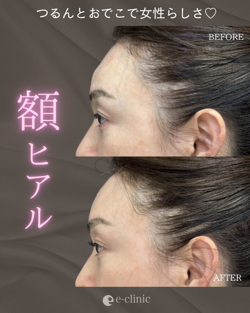 額のヒアルロン酸の症例写真