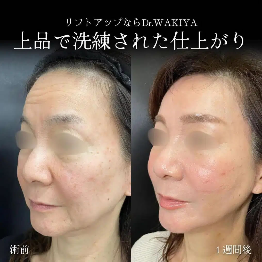 ほうれい線にヒアルロン酸を注入した女性の症例写真