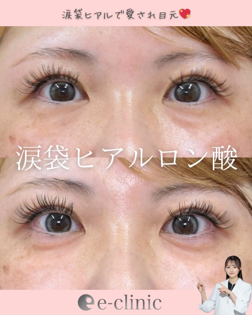 涙袋のヒアルロン酸の症例写真 (2)