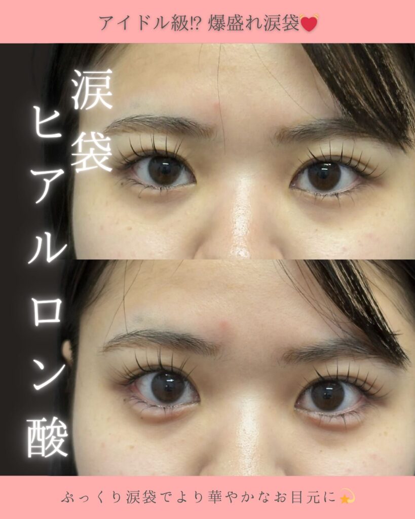 涙袋のヒアルロン酸の症例写真 (2)