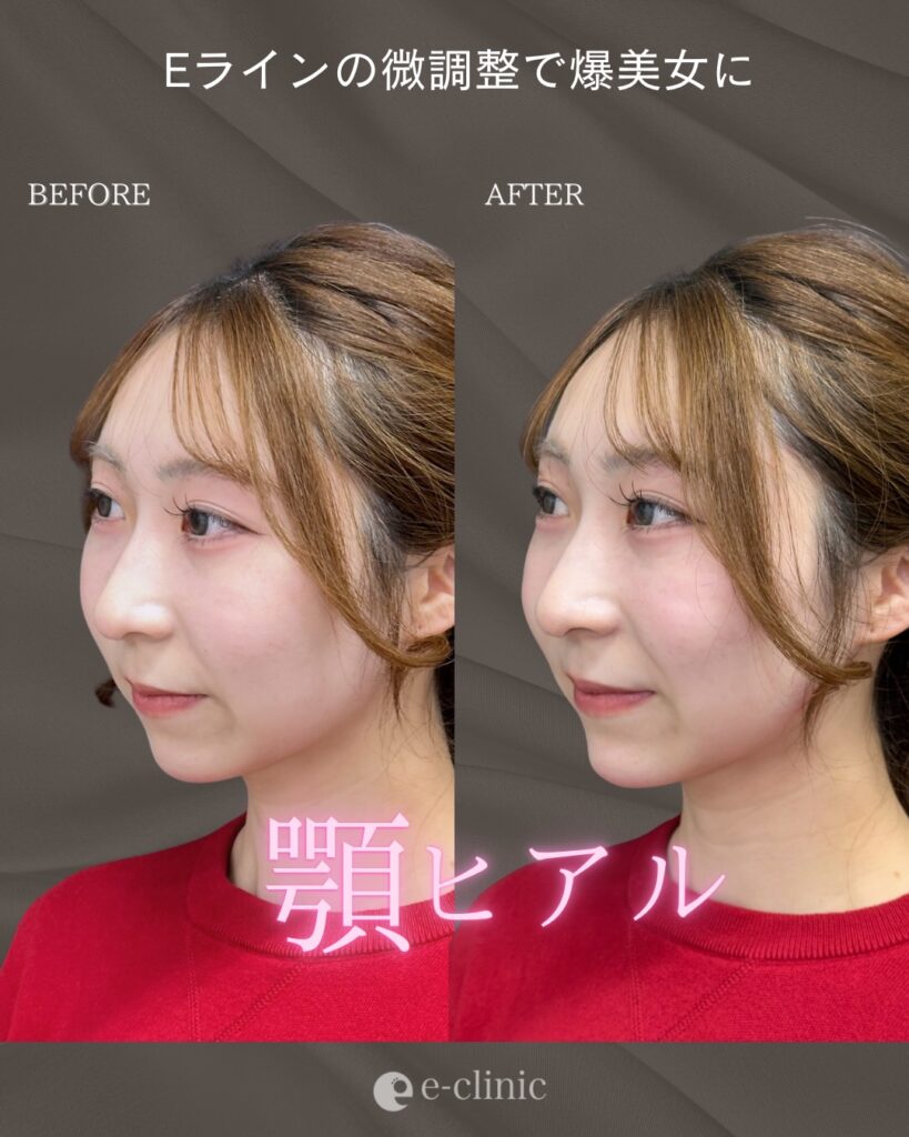 顎のヒアルロン酸の症例写真