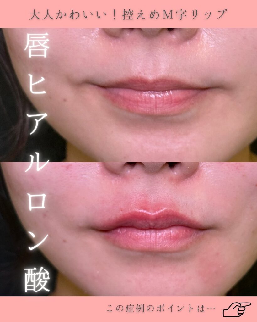 唇のヒアルロン酸の症例写真 (3)
