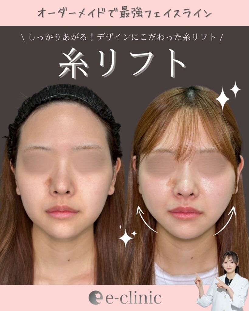 糸リフトの症例写真