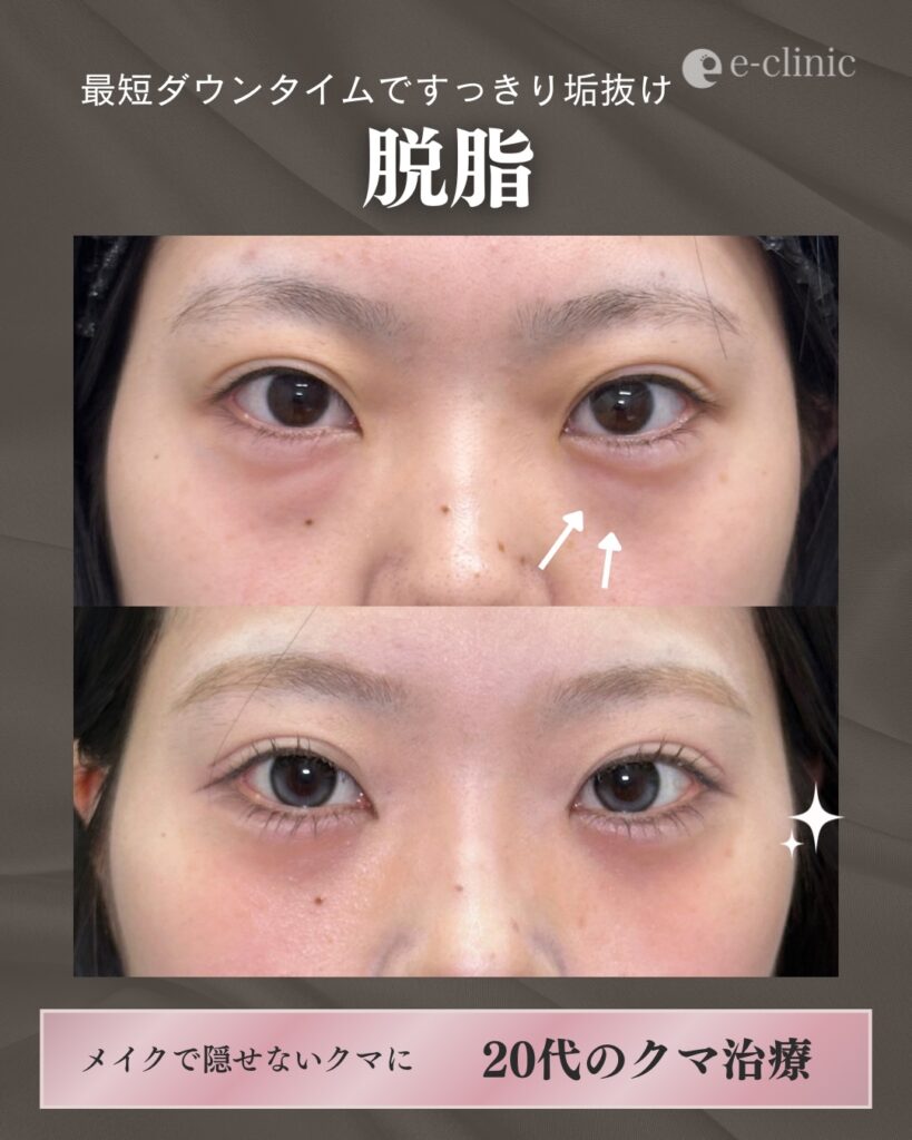 脱脂の症例写真