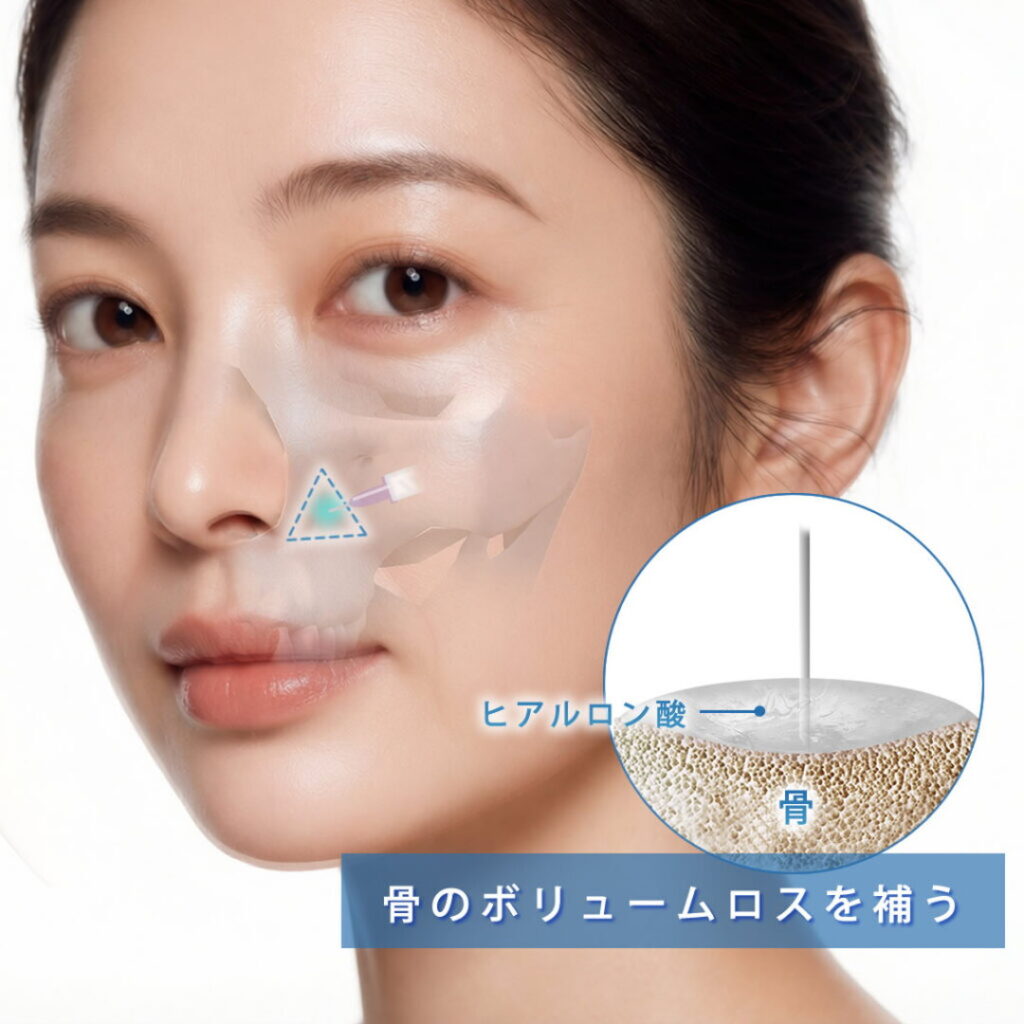 鼻翼基部の骨のボリュームロスを補うヒアルロン酸の注入の図解
