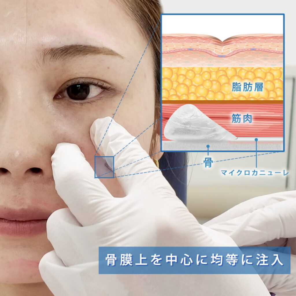 ゴルゴラインにヒアルロン酸をマイクロカニューレで注入している図解