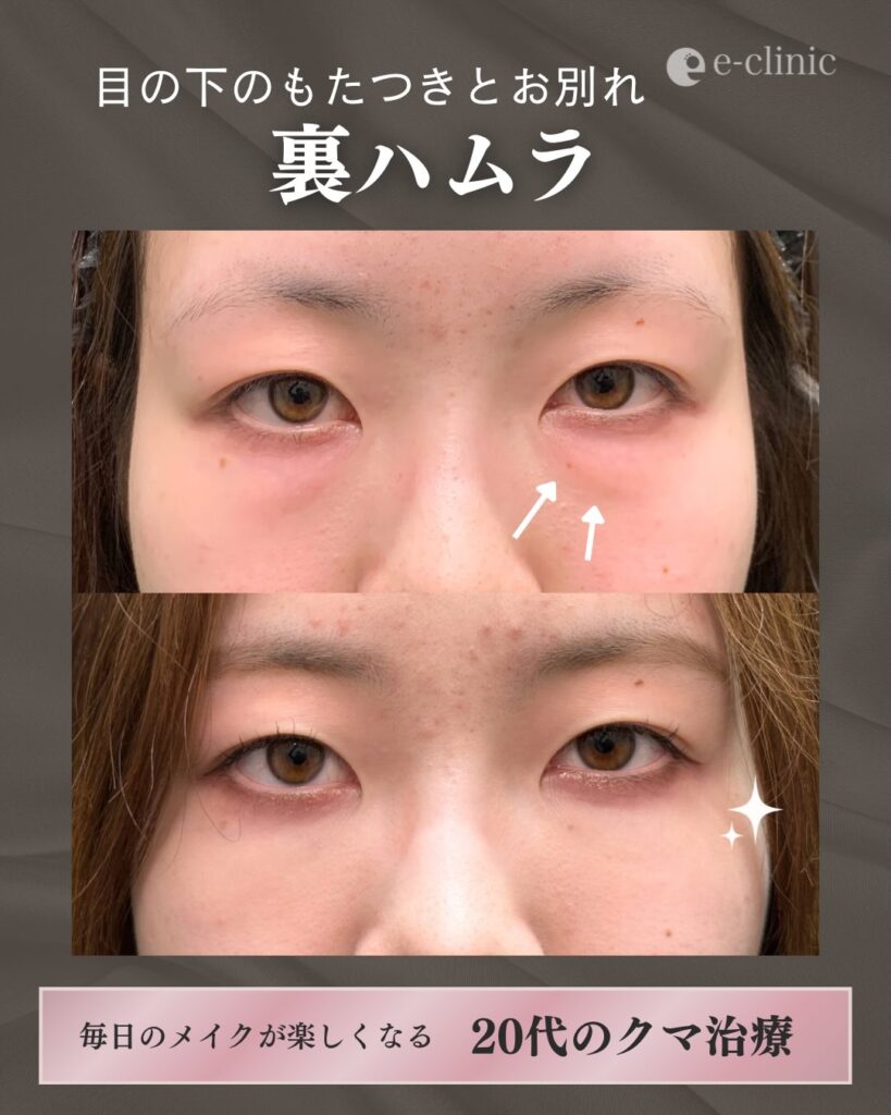 裏ハムラ法の症例写真 (15)