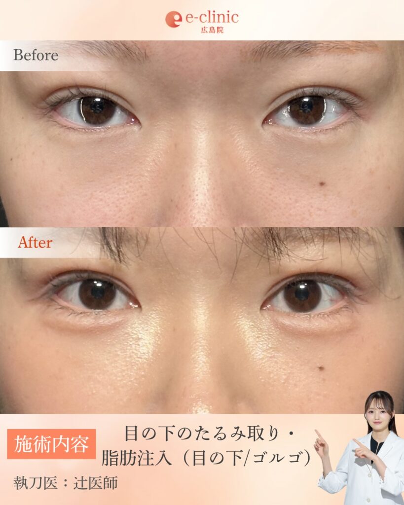 目の下のたるみ取り・脂肪注入の症例写真