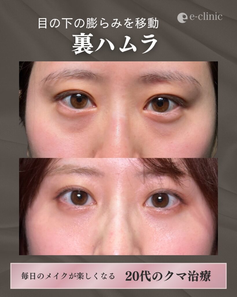 裏ハムラ法の症例写真 (14)