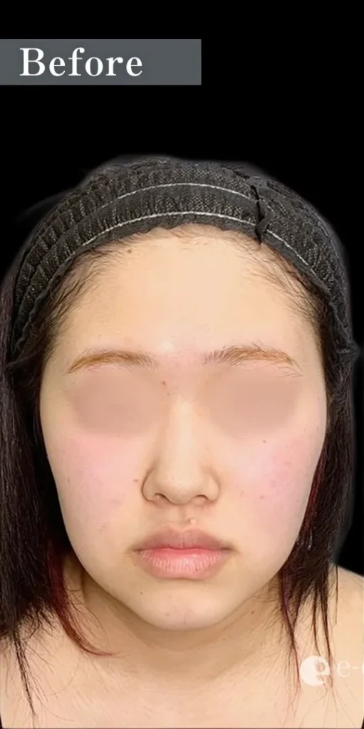 糸リフト＋脂肪吸引（顎下・頬ジョール）（辻一七子）（256） 1