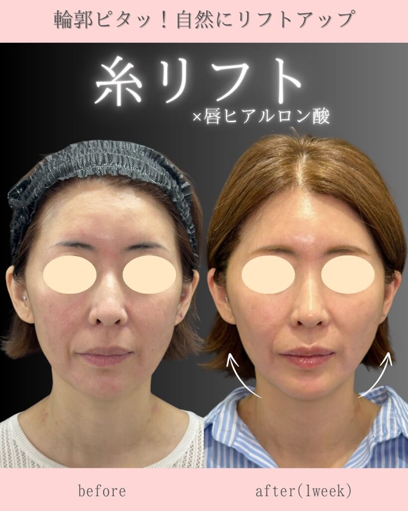 糸リフトと唇のヒアルロン酸の症例写真