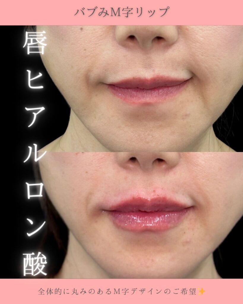 唇のヒアルロン酸の症例写真 (1)
