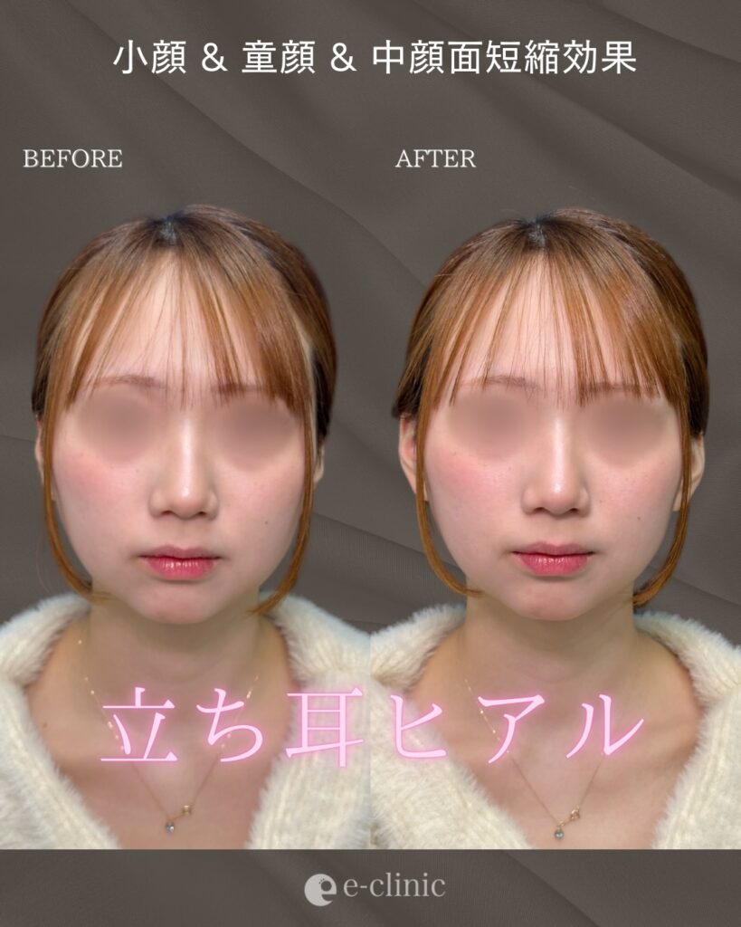 立ち耳ヒアルの症例写真