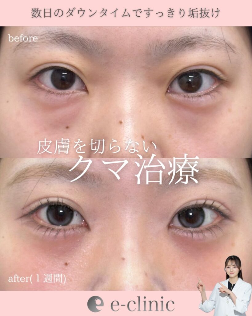 経結膜脱脂の症例写真 (2)