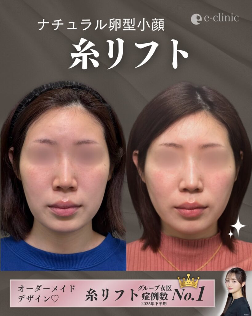 糸リフトの症例写真 (9)
