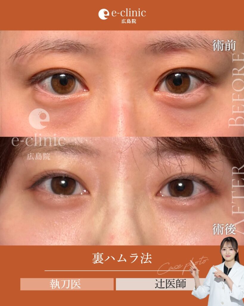 裏ハムラ法の症例写真