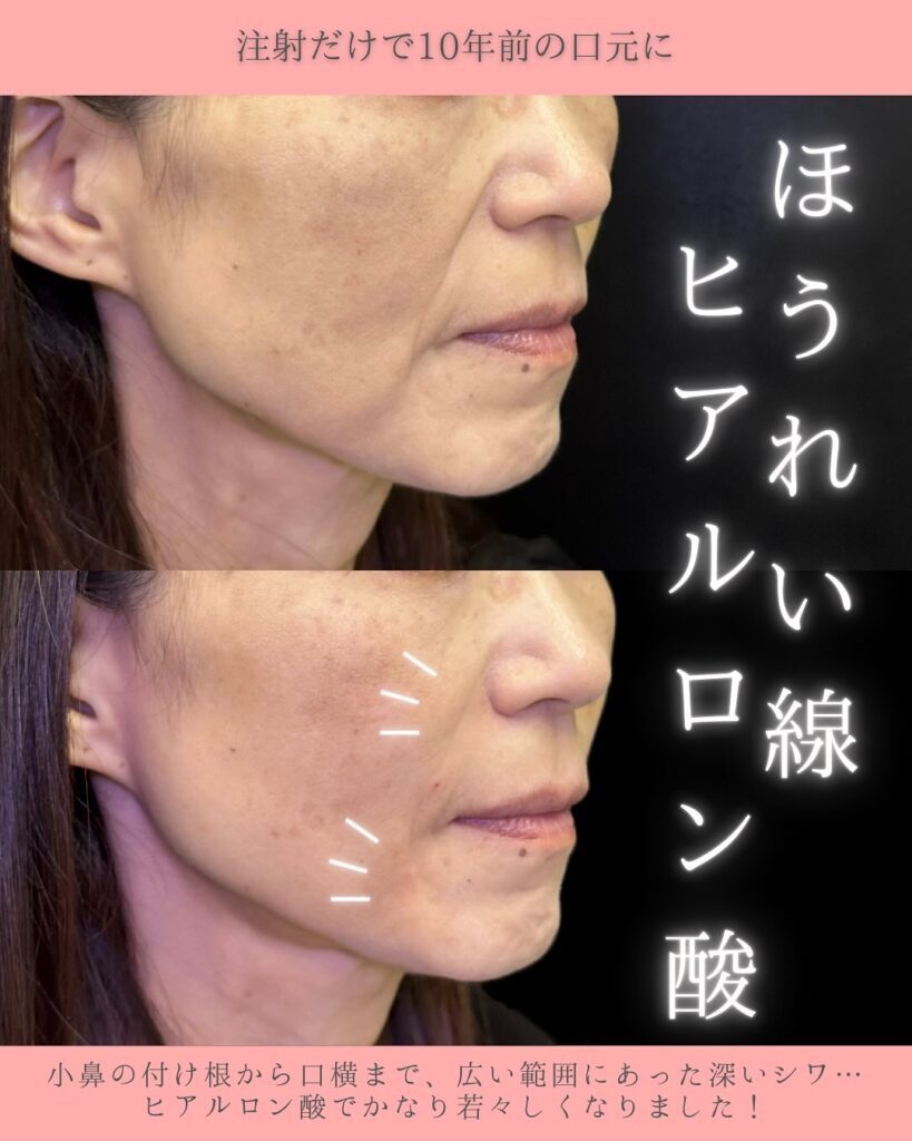 ほうれい線のヒアルロン酸の症例写真