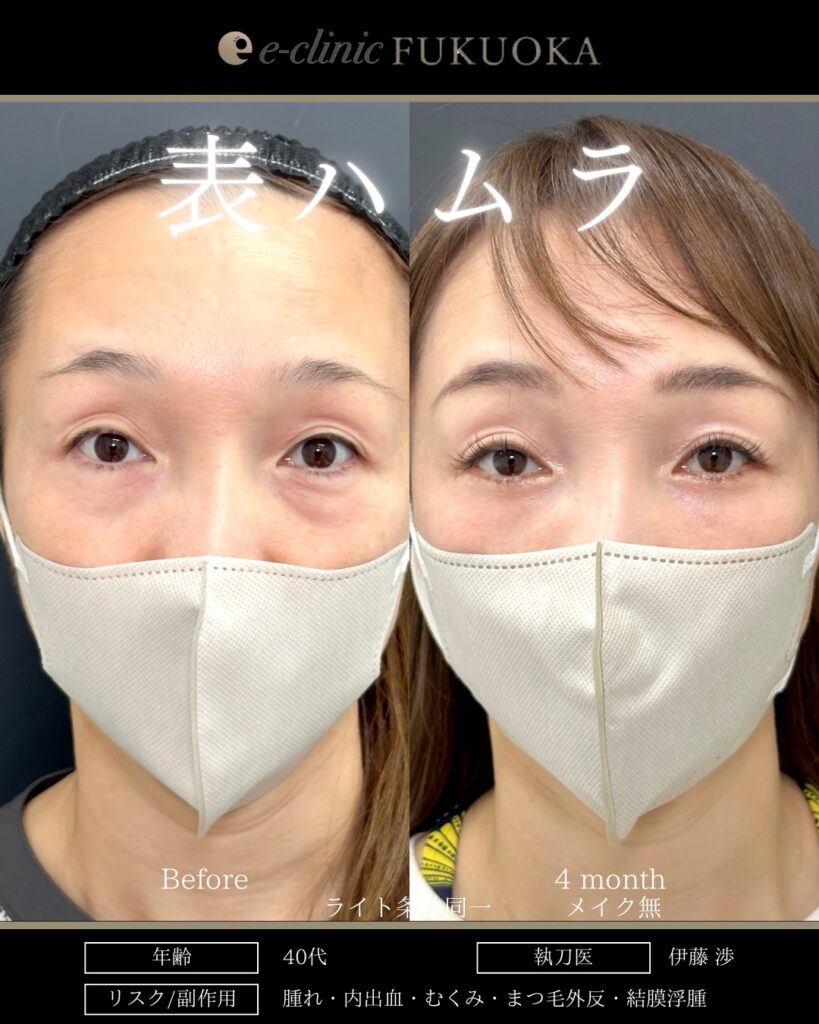 裏ハムラ法の症例写真 (13)