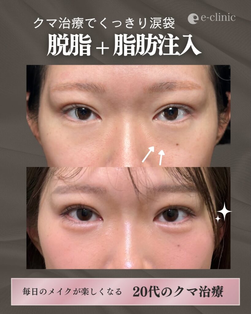 脱脂と脂肪注入の症例写真