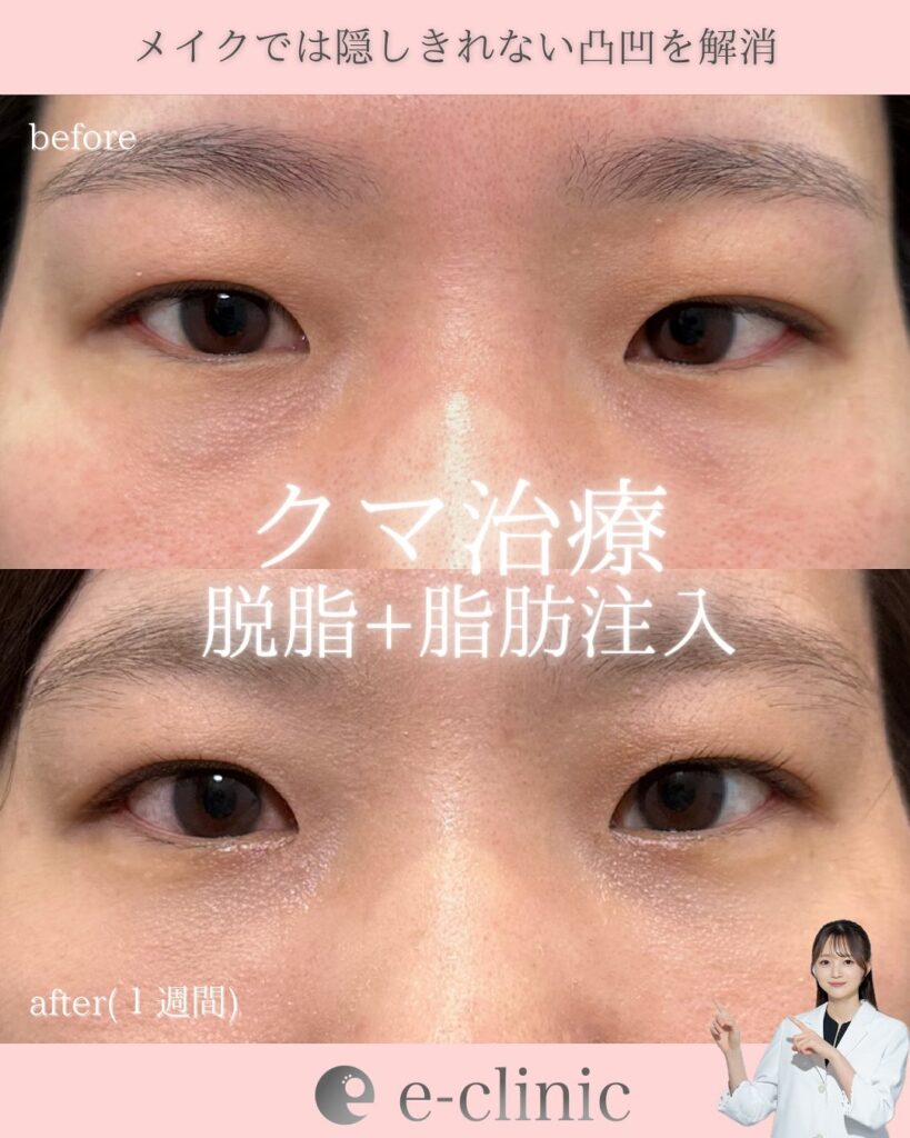 経結膜脱脂と脂肪注入の症例写真