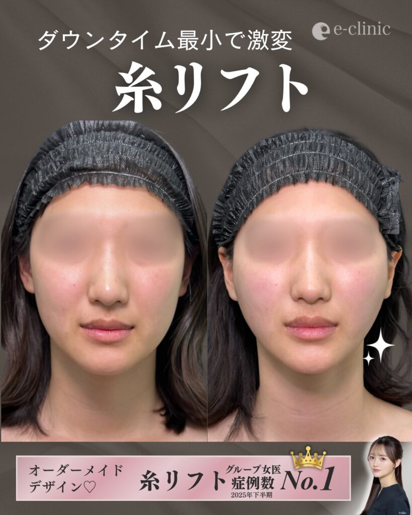糸リフトの症例写真 (10)