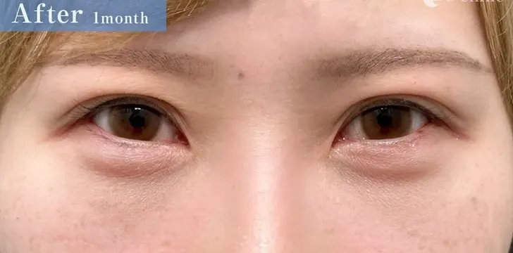 クマ取り_裏ハムラ（術後1ヶ月）（広島のクマ取り名医の辻一七子医師が執刀）