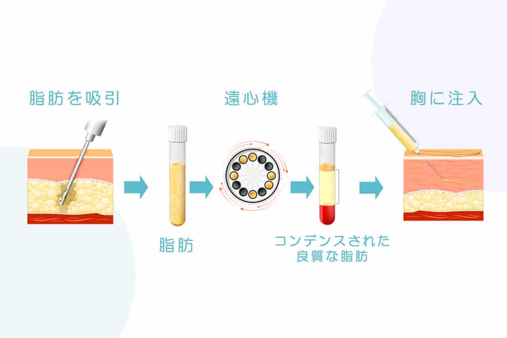 コンデンス豊胸の仕組み1